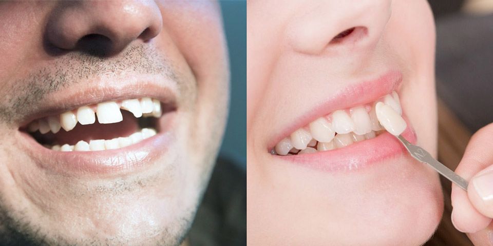 Dental bonding vs. porcelain veneers.