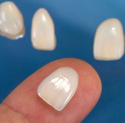 IPS Empress Veneers