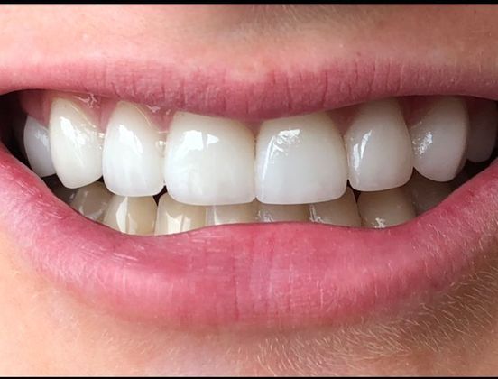 After porcelain veneers