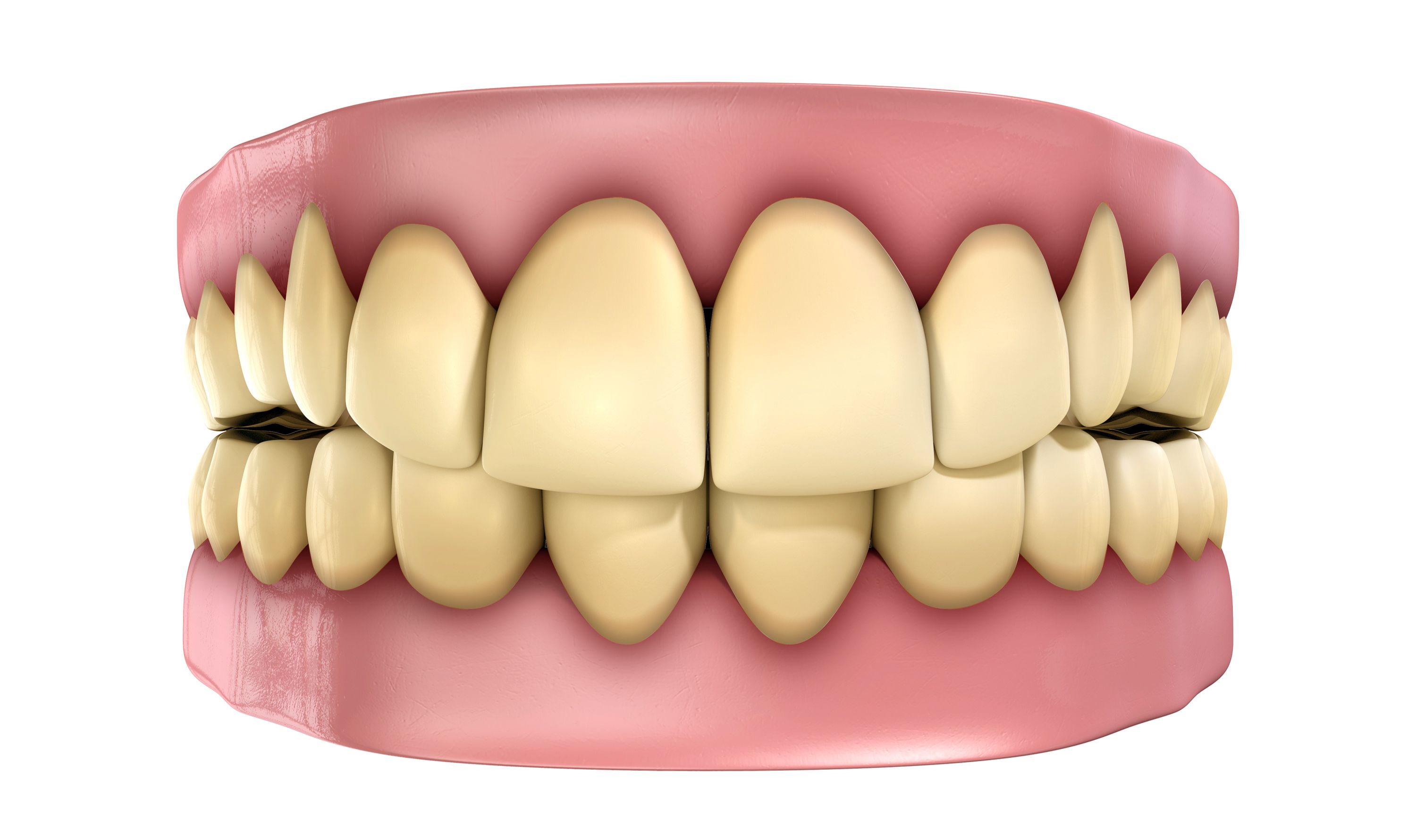 An illustration of teeth that are discolored.